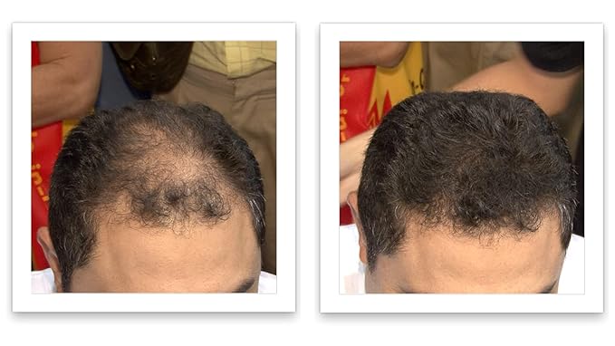 Hair Loss Concealer. Cover Bald Spot and Thinning Hair Instantly. Make Thin Hair Look 10X Fuller. All-Natural Hair Building Fiber. Trial Size (10-Day Supply). Dark Brown