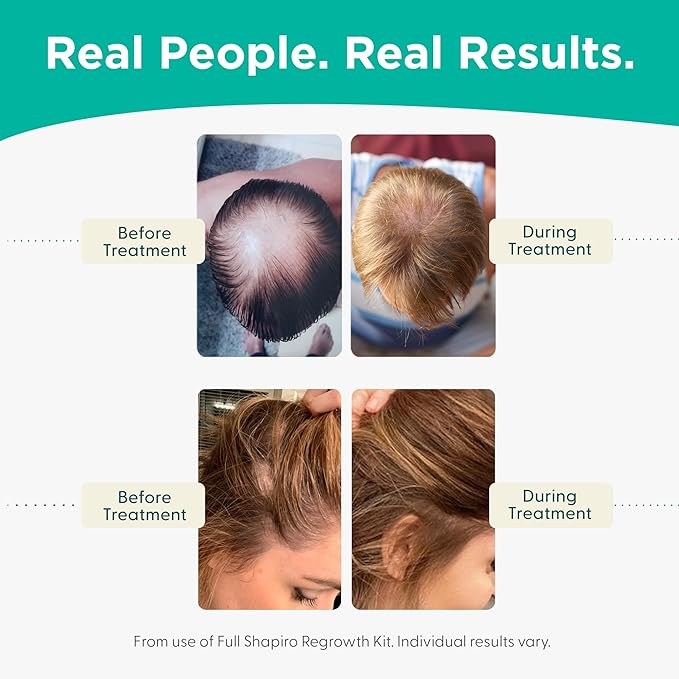 Shapiro MD Hair Growth Experts Hair Loss Conditioner, DHT Fighting Vegan Formula for Thinning Hair Developed by Dermatologists, Experience Healthier, Fuller and Thicker Looking Hair, 1 Month Supply