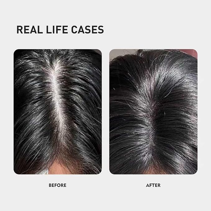 KINTOR 0.9% KX-826 DHT Blocker for Men & Women Hair Growth,Hair Growth Products Foam 120ml Pro