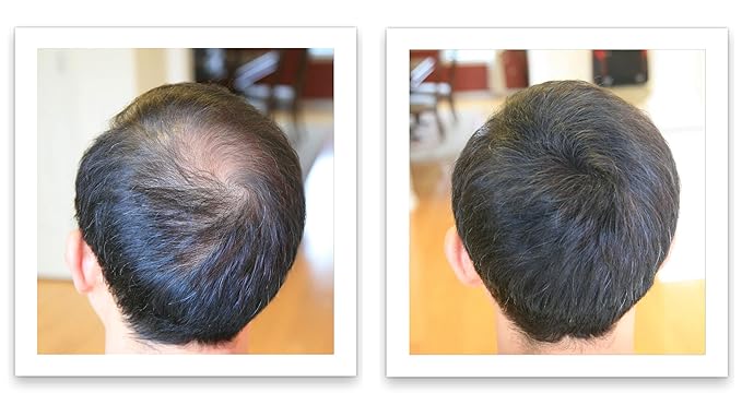 Caboki 10X Volumizing Hair Powder for Thinning Hair: Root Touch Up for Men and Women, Fill in Hairline & Edges, Cover Bald Spots. TALC-Free, Dark Gray
