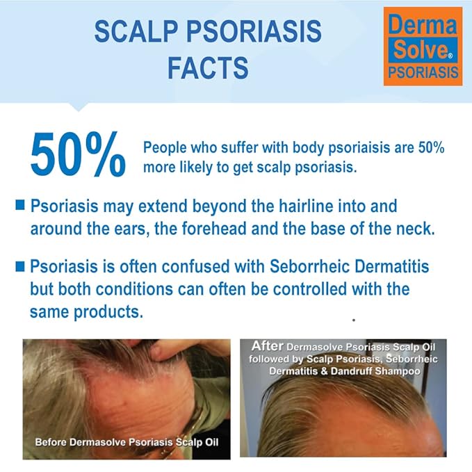Dermasolve Scalp Psoriasis Medicated Shampoo & Conditioner - Naturally Heals Dandruff Seborrheic Dermatitis Itchy Flakey Inflamed Skin & Provides Soothing Moisturizing Relief - 8 oz bottles (2 Pack)