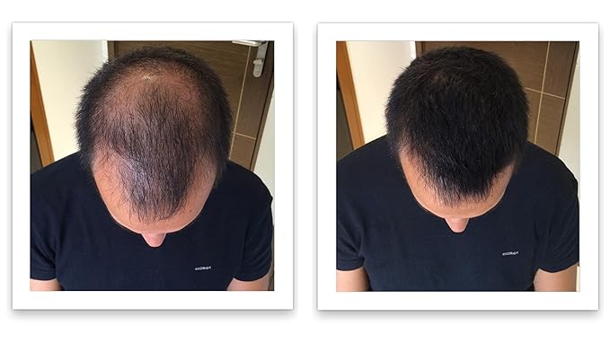 Hair Powder For Thinning Hair. Makes Thin Hair Look 10X Fuller, Covers Bald Spot Instantly. All-Natural Hair Building Fiber. Trial Size (10-Day Supply). Black