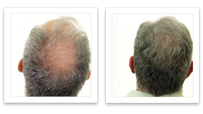 Trial Size - Make Thin Hair Look 10X Fuller. Eliminate Bald Spot and Thinning Hair Instantly. All-Natural Hair Concealer. Salt & Pepper - Light
