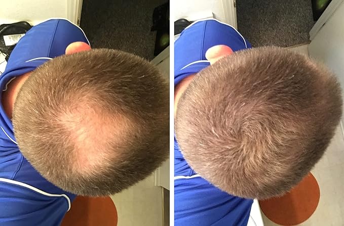 Quick Fix For Thinning Hair and Bald Spot. Get 10X Fuller Hair Instantly. All-Natural Hair Building Fiber For Hair. Trial Size (10-Day Supply). Light Brown