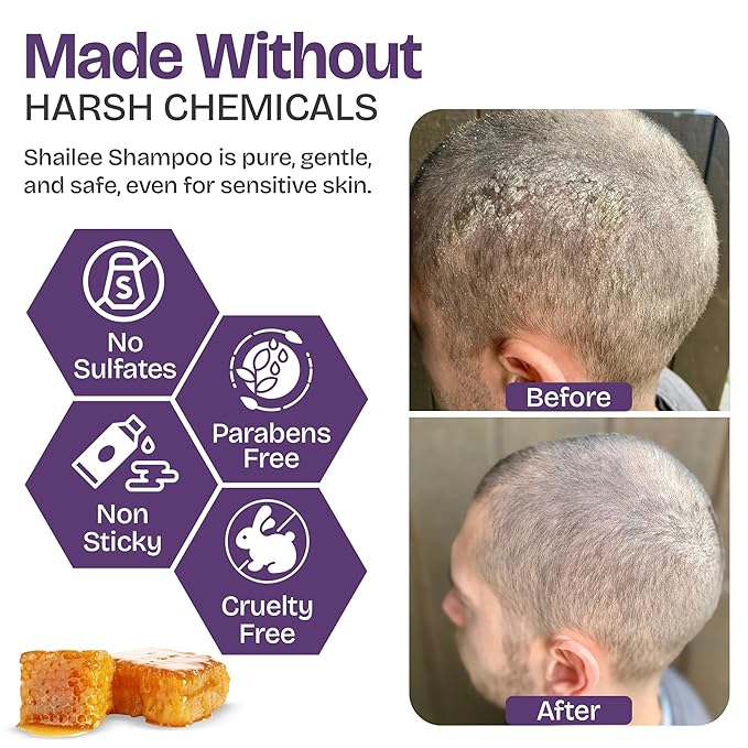 Psoriasis Shampoo for Eczema, and Folliculitis Treatment - Seborrheic Dermatitis Antifungal Shampoo for Ringworm, Acne, Flaking, Dry & Itchy Scalp Treatment - Psoriasis Relief with Manuka Honey