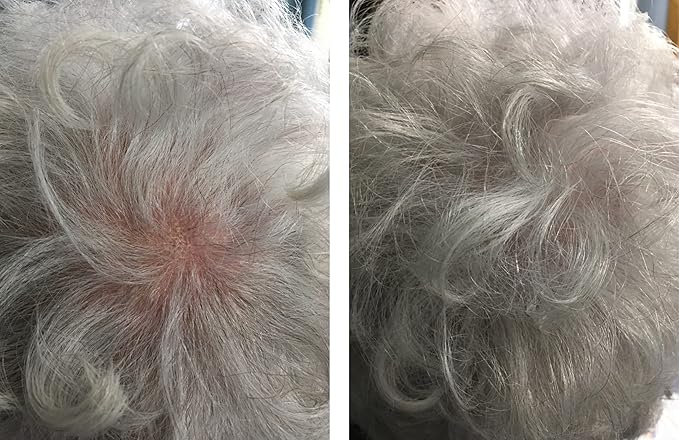 Hair Thickening Fibers. Cover Bald Spot and Thinning Hair Instantly. Make Thin Hair Look 10X Fuller. All-Natural Hair Building Fiber. Trial Size (10-Day Supply). Silver/White