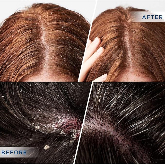 Psoriasis & Seborrheic Dermatitis Shampoo with 2% Salicylic Acid: Dandruff Scalp Treatment, Soothes Flaking, Itching, Redness, Anti Fungal Medicated Formula with Botanical Folliculitis Support