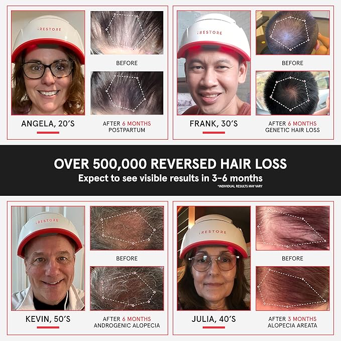 iRestore Professional + Rechargeable Battery Pack - Laser Red Light Therapy for Hair Growth - FDA Cleared Hair Loss, Thinning Treatment for Men & Women - Hair Regrowth Cap - 282 Lasers & LEDs